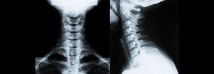 Poor Posture Series: 6 Issues Arising From Forward Head Posture
