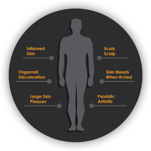 psoriasis symptoms