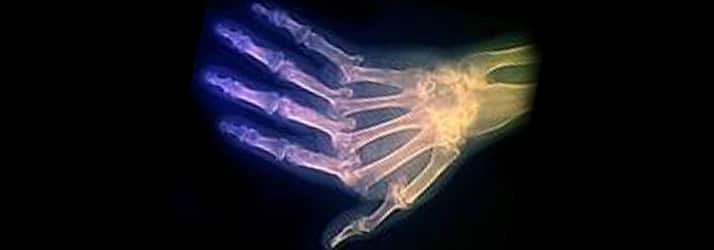 X-ray of hand